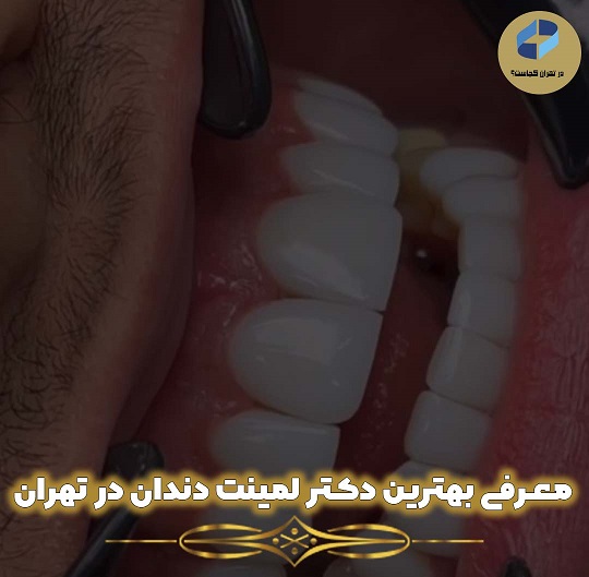 دکتر لمینت دندان در تهران
